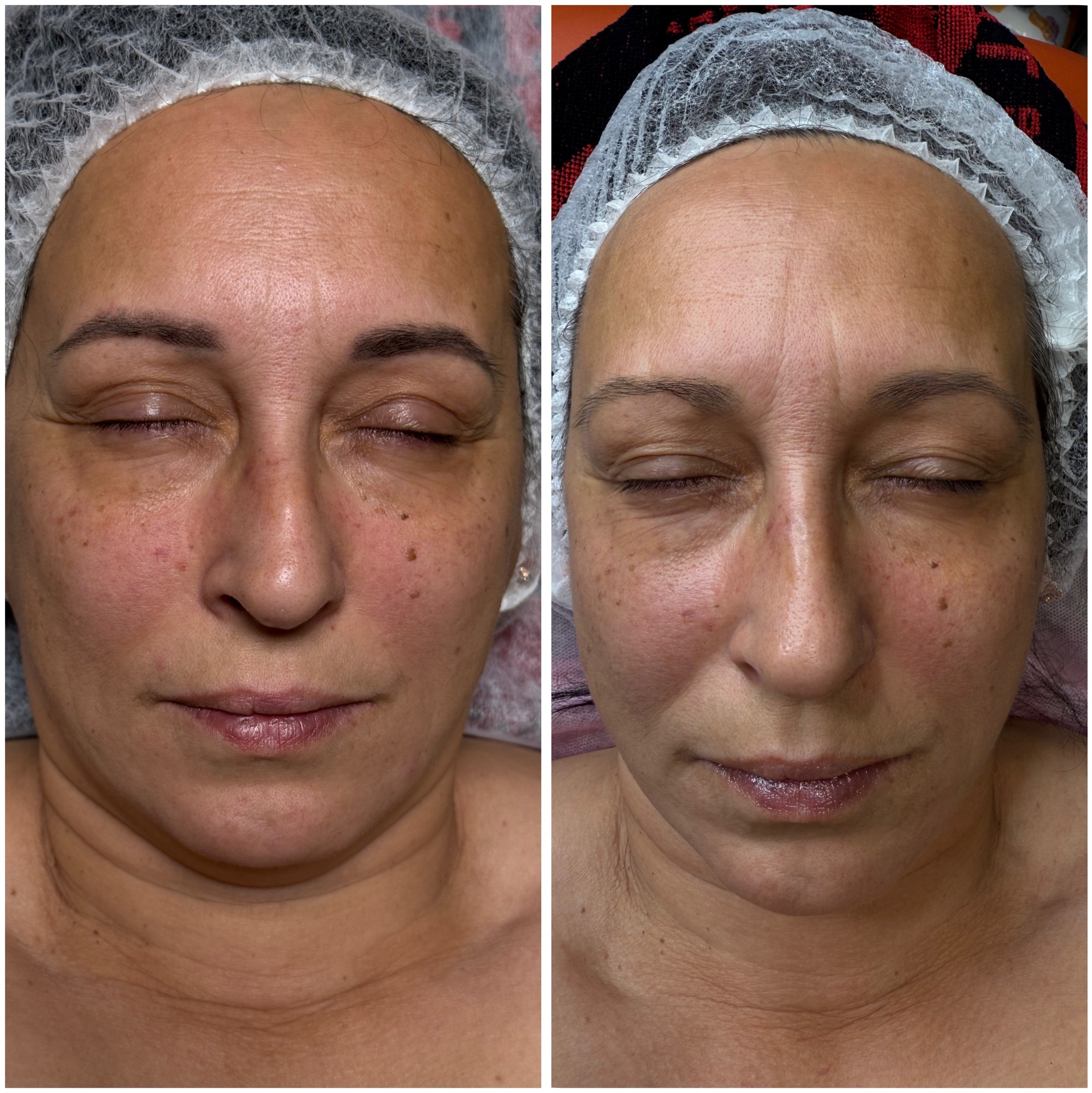 Sejas liftinga Vakummasāža ,rezultāts pēc 10x